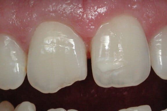 Before Bonding Benefits