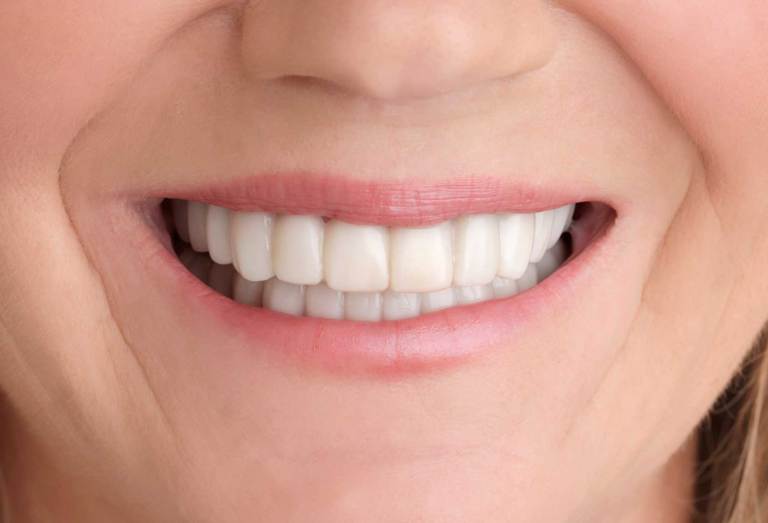 After Beautiful Smile with Snap-On Smile