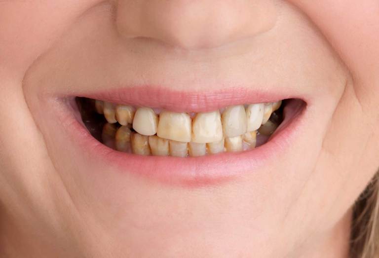 Before Beautiful Smile with Snap-On Smile