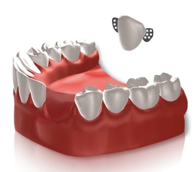 Dr. Tawill DDS - Bonded Bridge