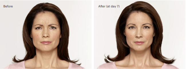 Alecia Botox Before and After photo A