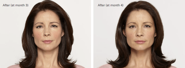 Alecia Botox Before and After photo B