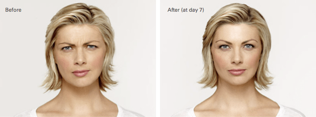 Amy Botox Before and After photo A