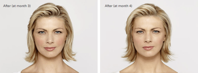 Amy Botox Before and After photo B