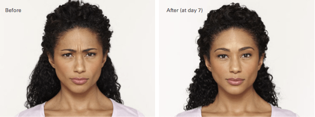 Glynnis Botox Before and After photo A