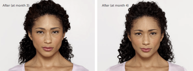 Glynnis Botox Before and After photo B