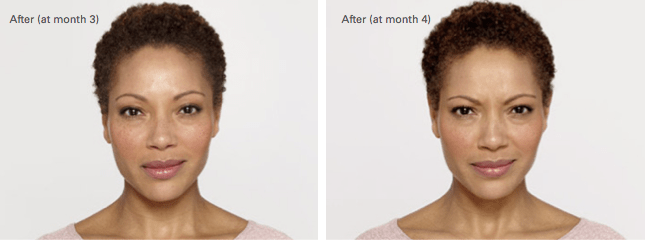 Glynnis Botox Before and After photo B