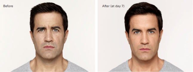 Jonathon Botox Before and After photo A