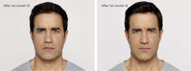 Jonathon Botox Before and After photo B