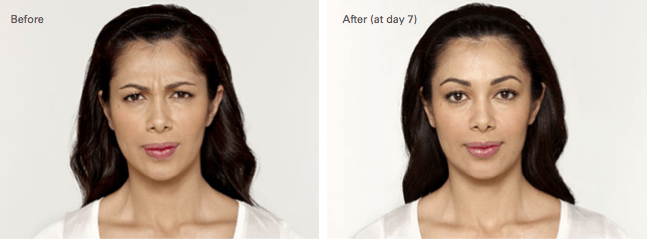 Luz Botox Before and After photo A