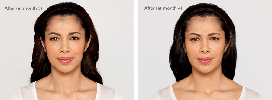 Luz Botox Before and After photo B