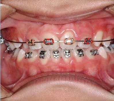 Dr. Tawill DDS - Conventional Braces