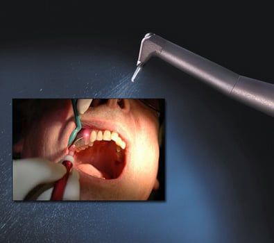Dr. Tawill DDS - Soft Tissue Laser