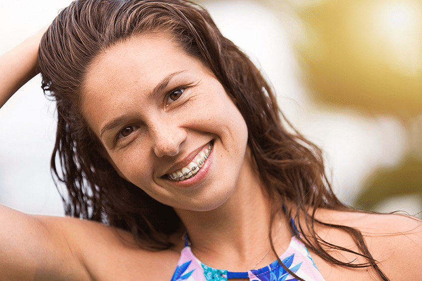 Translucent Cosmetic Braces  Greater Vancouver Orthodontics