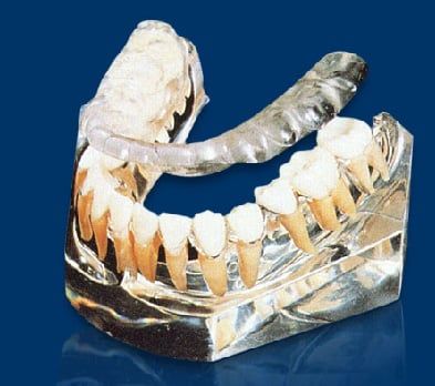 Bite Splints - Atlanta Dentist Dr. J. Patrick Posey