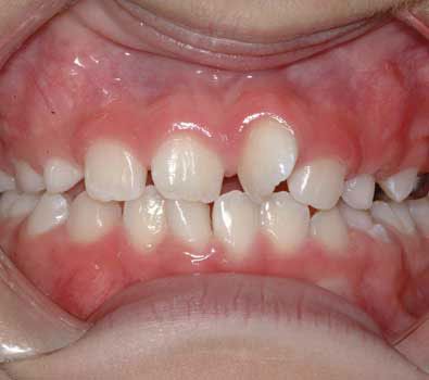 My child has crooked teeth; will he or she need braces?