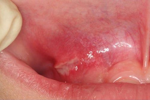 Canker Sores After Wisdom Tooth Removal