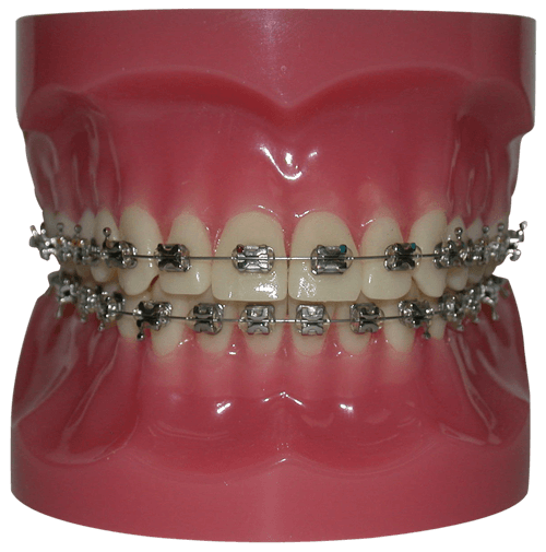 Conventional Braces - West Vancouver Dentist Dr. Brett Coyle