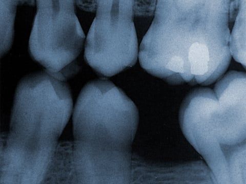 Digital X-Rays - West Vancouver Dentist Dr. Brett Coyle