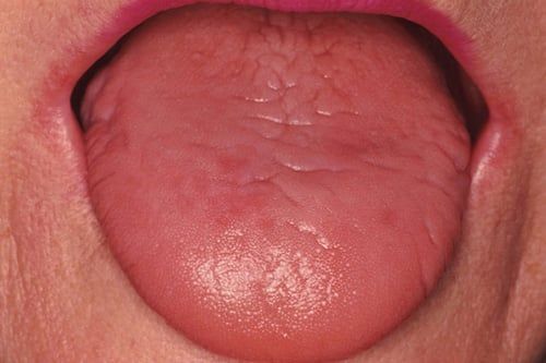 Dry Mouth - Atlanta Dentist Dr. J. Patrick Posey