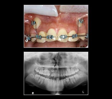 Impacted Canine