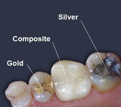 Types of Fillings, Dental Teeth Fillings | Bennett Family Dentistry in ...