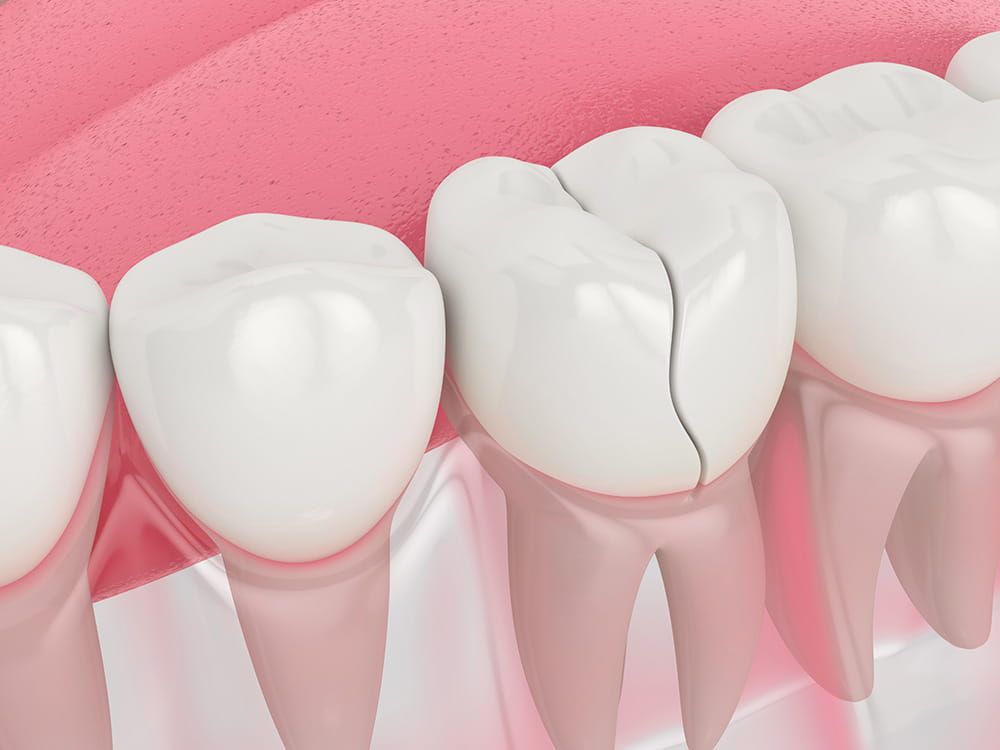 Tooth Fractures - Atlanta Dentist Dr. J. Patrick Posey