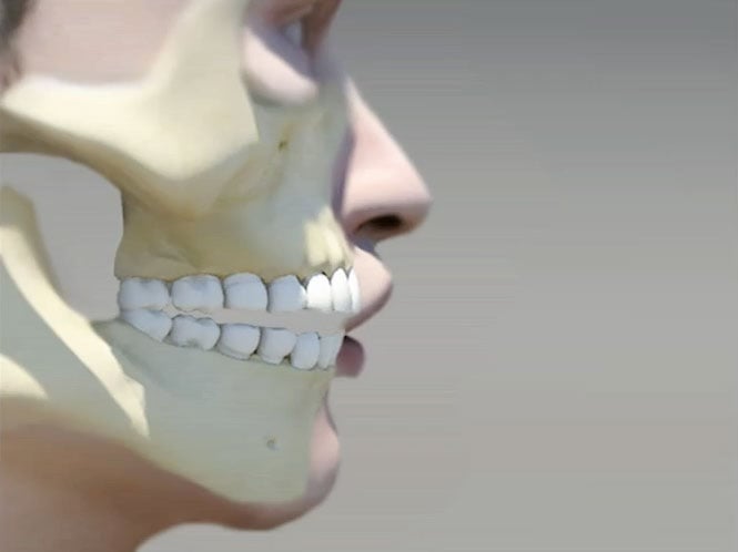Invisalign can treat: Open Bite, a common orthodontic condition