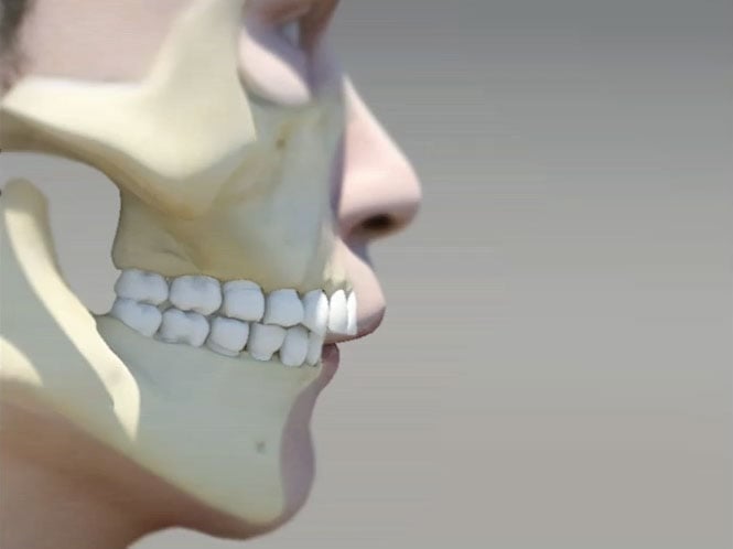 Invisalign can treat: Over Bite, a common orthodontic condition