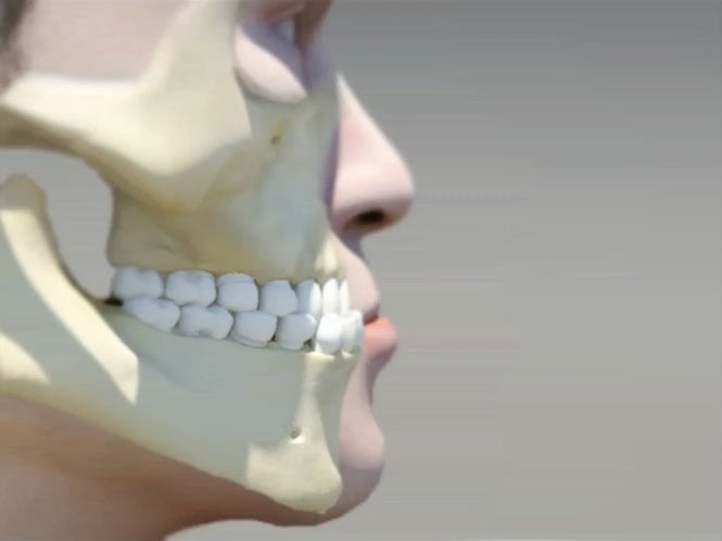 Invisalign can treat: Underbite, a common orthodontic condition