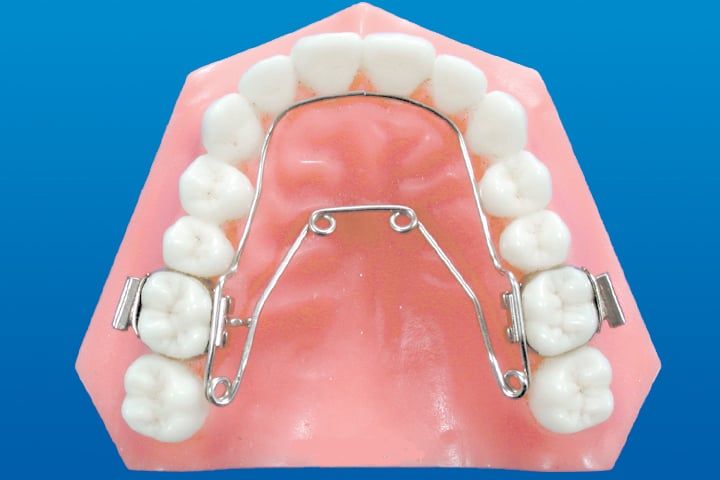 Orthodontic Wilson 3D Appliance