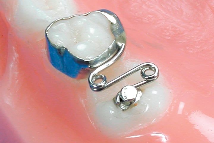 Ortho Spring Distalizer