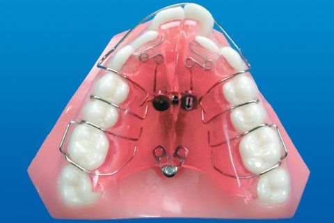 Orthodontics Swing Lock Expander
