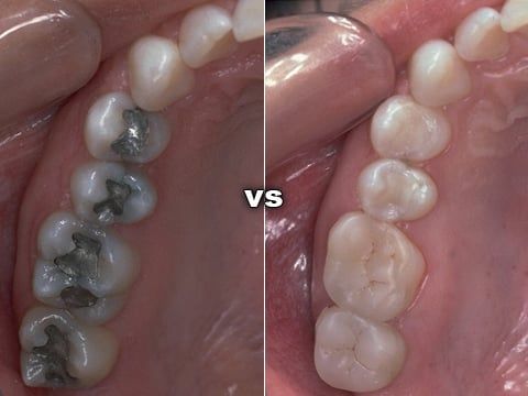 Tooth-colored Composite Fillings To Replace Silver