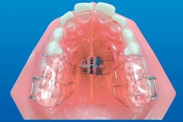 Orthodontic Twin Block