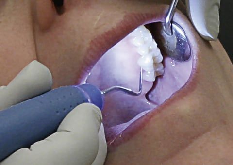 Micro Ultrasonic Scaling - Atlanta Dentist Dr. J. Patrick Posey