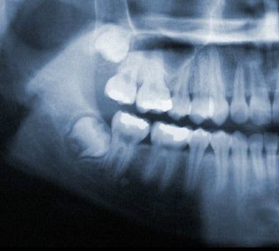 Wisdom Tooth Positions - Atlanta Dentist Dr. J. Patrick Posey