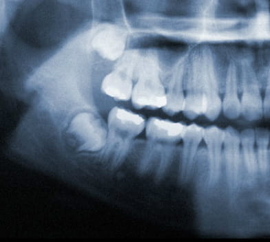 horizontal impacted wisdom teeth